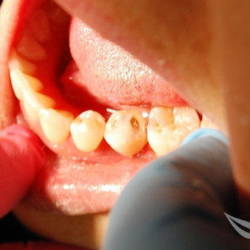 Экспресс имплантации зубов до и после
