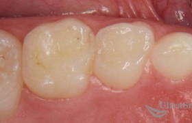 Разделение рядом стоящих зубов