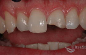 Реставрация переднего зуба