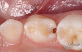 Лечение кариеса между зубов
