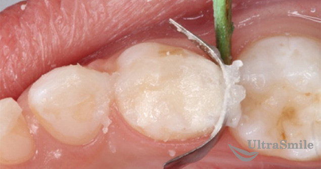 Лечение кариеса между зубов