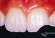 3 метода, как восстановить сколы передних зубов