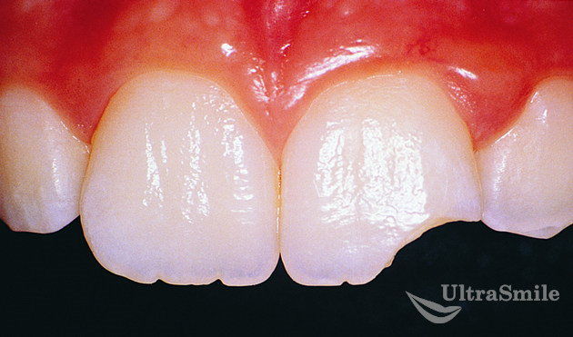 3 метода, как восстановить сколы передних зубов
