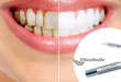 Карандаш для отбеливания зубов: правила выбора и использования