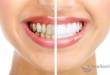 6 методов удаления зубного налета