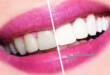 Фотоотбеливание зубов: методы и их эффективность