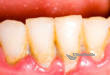 ТОП-5 проблем, к которым приводит зубной налет