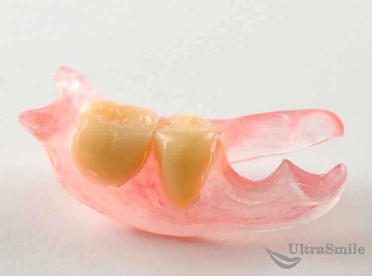Зубной протез «бабочка»: что скрывается за необычным названием?