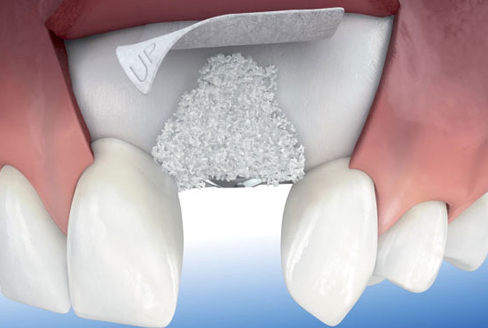5 способов наращивания костной ткани челюсти