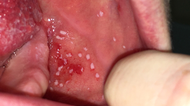 Анестезия после лечения зуба последствия thumbnail