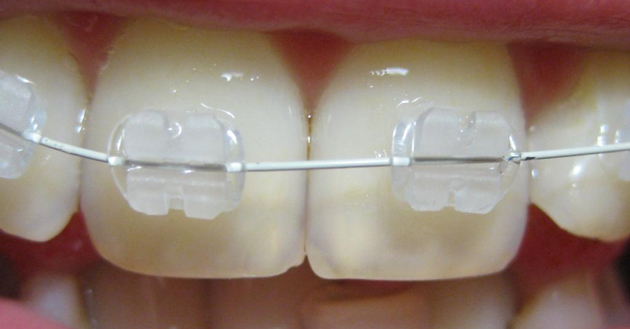 Зубы клиновидный дефект до и после лечения thumbnail
