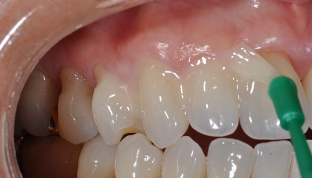 Народные средства лечения клиновидного дефекта зубов thumbnail