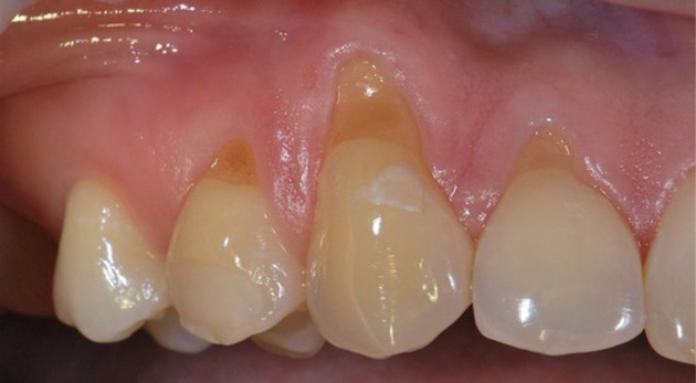 Клиновидный дефект зуба боль после лечения thumbnail