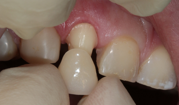Клиновидный дефект зубов причины и лечение в домашних условиях отзывы thumbnail