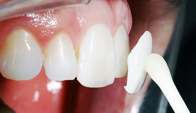Клиновидный зуб народные лечения thumbnail