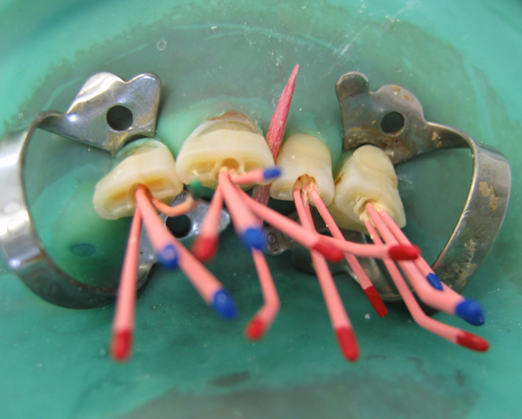Гуттаперча в стоматологии: 6 преимуществ использования