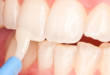 3 варианта, как провести фторирование для укрепления эмали зубов