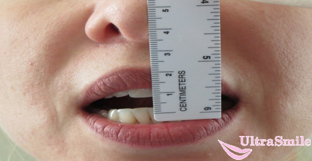 Насколько широко. Ограничение открывания рта. Степень открывания рта. Измерение ширины открывания рта. Степень открывания р а.