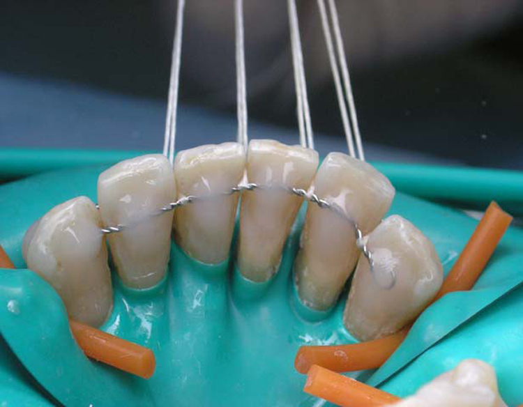 3 способа шинирования зубов