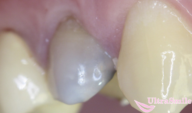 Болит зуб после удаления нервов с мышьяком thumbnail