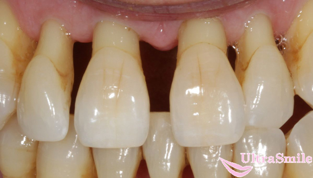 Оголяется шейка зуба лечение фото thumbnail