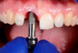 6 самых актуальных вопросов про имплантацию сразу после удаления зуба