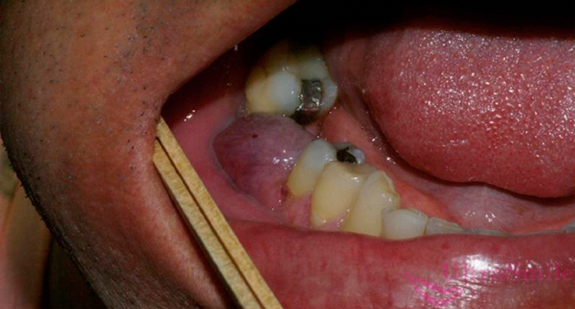 Удалили зуб теперь болят десны thumbnail