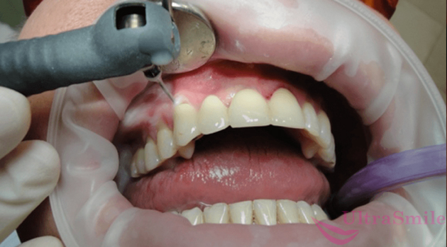 Один зуб подвижен лечение thumbnail