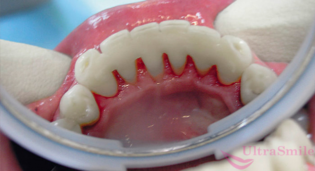 Подвижные зубы лечение народными средствами thumbnail