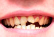 5 полезных советов для тех, у кого крошатся зубы