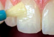 6 предостережений для тех, кто хочет провести фторирование зубов дома