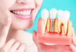9 услуг, которые обязательно включены в имплантацию зубов «под ключ»