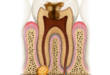 3 основных метода лечения гранулемы с гноем на корне зуба