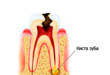8 типов зубных кист, а также методы их лечения