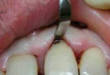 Поддесневой зубной камень: причины появления, опасные последствия и методы удаления