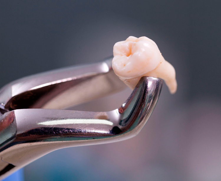 5 этапов, из которых состоит удаление зуба