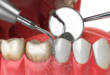 6 этапов профессиональной чистки зубов с фото до и после
