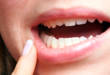 Как называется белая болячка во рту: 6 наименований, о которых вы могли не знать