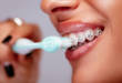 Как и чем чистить зубы с брекетами: советы ортодонтов
