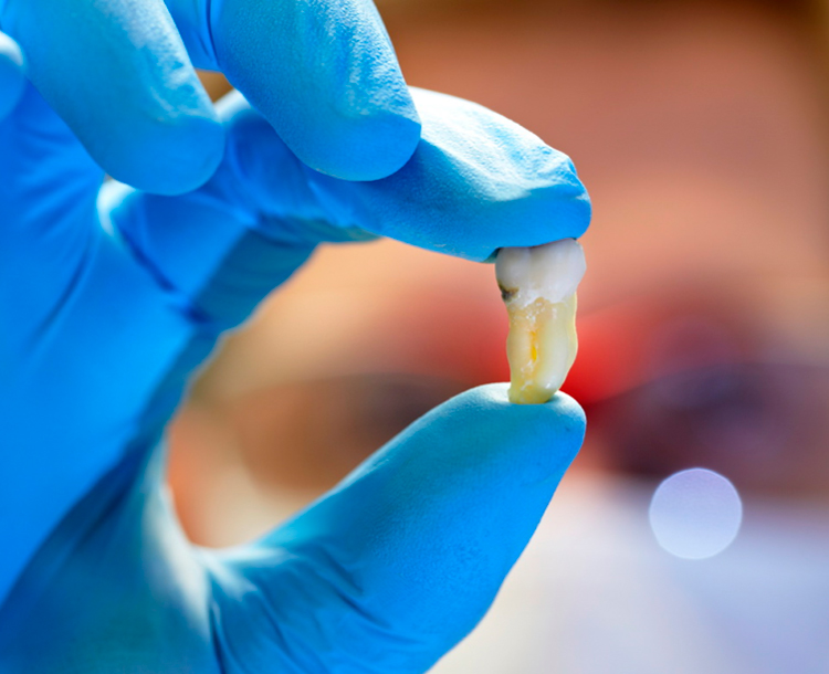 Как вставить зуб обратно без протезирования и имплантации: о том, что такое реплантация