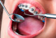 Как ставят брекеты на зубы: этапы и особенности, на которые важно обратить внимание