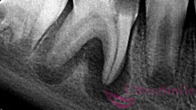 Периодонтит - воспаление у верхушки корня зуба
