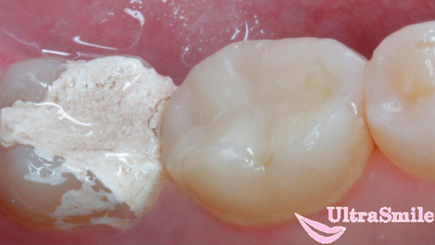 Многие пациенты жалуются, что у них болит зуб после пломбировки каналов пастой с мышьяком