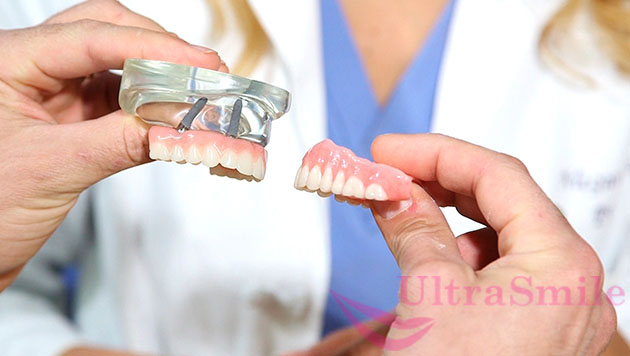 После ношения вставных зубов многие пациенты решаются на полноценную имплантацию и несъемное протезирование