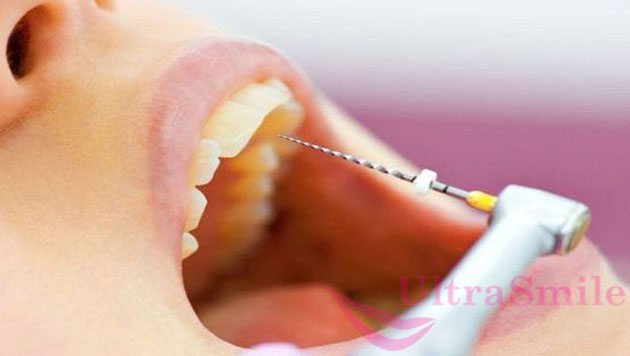 Нерв из зуба удаляют в случае острого воспаления пульпы 