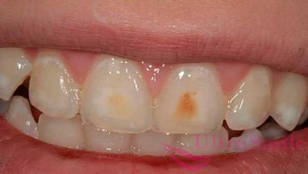 Поверхностный кариес развивается вслед за начальным, характеризующимся очагами деминерализации зубной эмали и появлением на ней белых меловидных пятен (они матовые, без блеска).