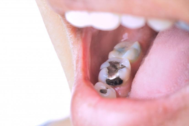 10 познавательных фактов про зубную пломбу из амальгамы