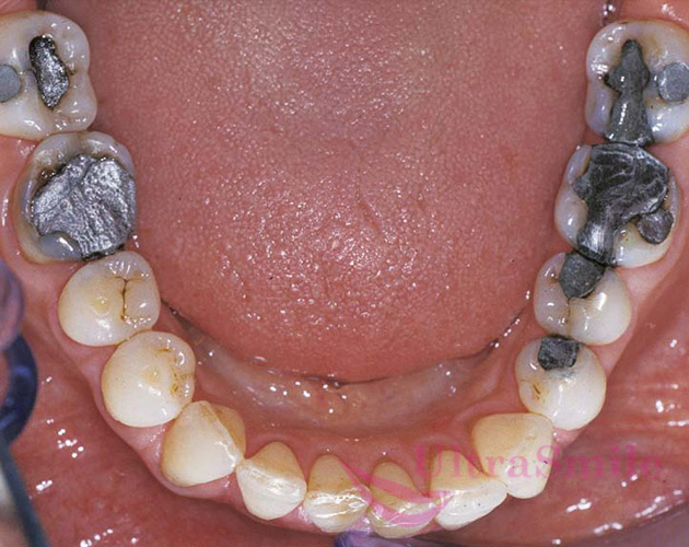 Амальгама на жевательные зубы