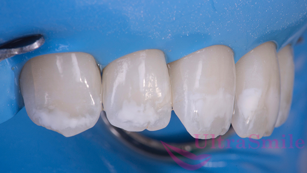 Процесс деминерализации твердых тканей зубов