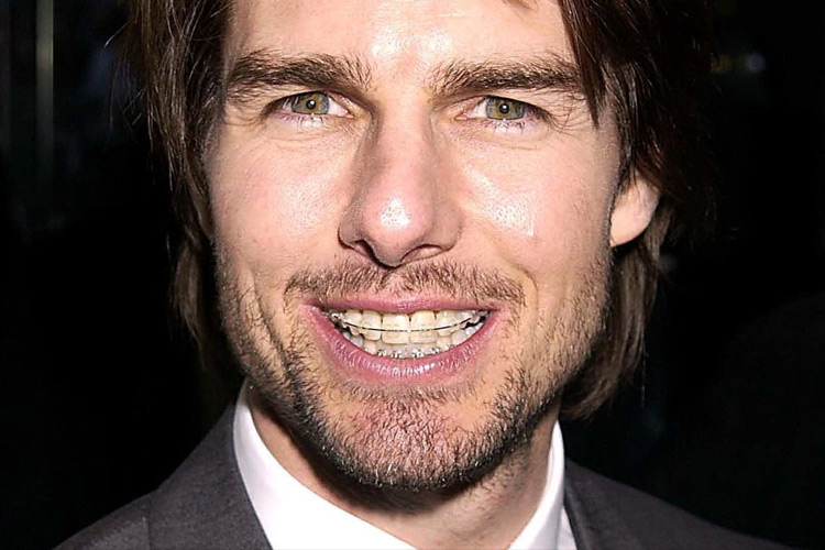 Популярные брекеты среди знаменитостей: красивые зубы на фото
